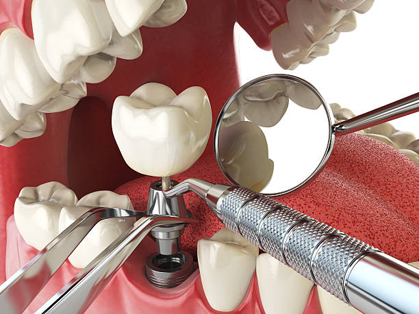 Best Dental Abscess Treatment in Kingston Springs, TN